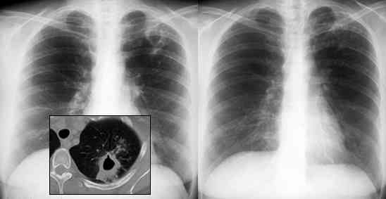 tuberculosis x ray. Chest x-ray after healing with