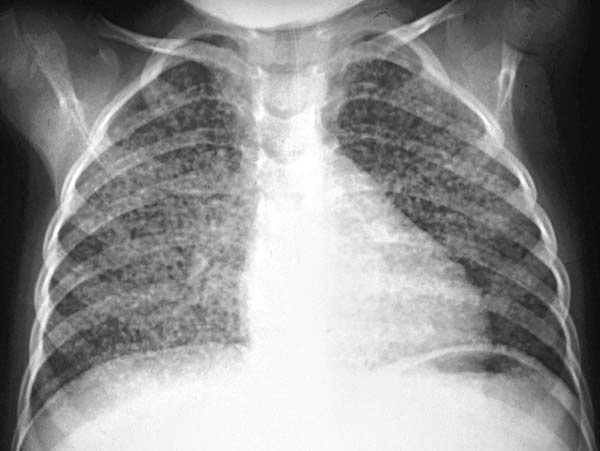 tuberculosis x ray. Newborn with miliary TB