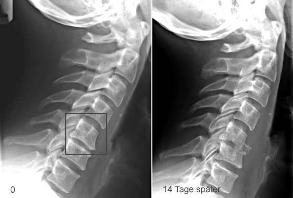 Sammlung Radiologie Tuberkulose