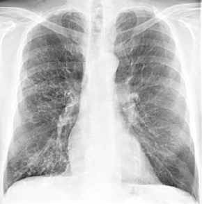 Der weiße flecken lunge auf Röntgen