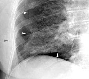Lunge röntgenbild weiße flecken