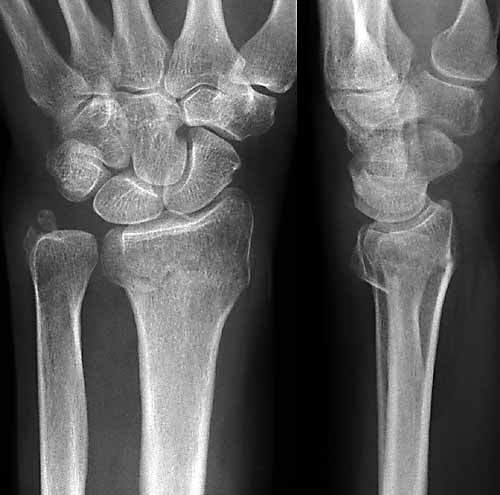 Skelett Trauma RÃ¶ntgendiagnostik Handgelenk und Handwurzel.