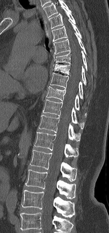 Skelett Trauma R ntgendiagnostik Wirbels ulentrauma