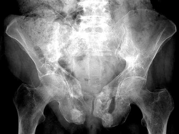 Skelett Trauma Röntgendiagnostik Beckenfrakturen
